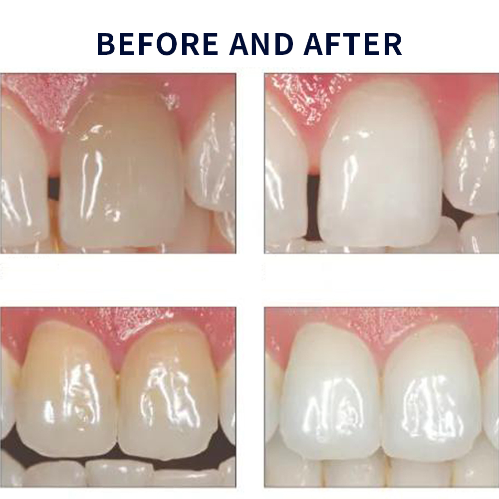 Opalescence Whitening 20% PF 2 - Teeth Whitening Kit At Home review and price