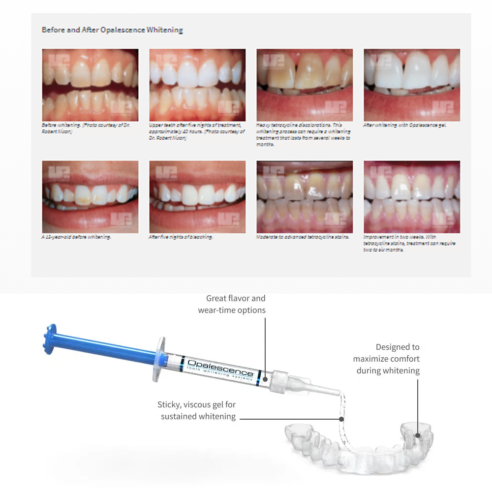 Opalescence Whitening 20% PF 2 - Teeth Whitening Kit At Home review and price