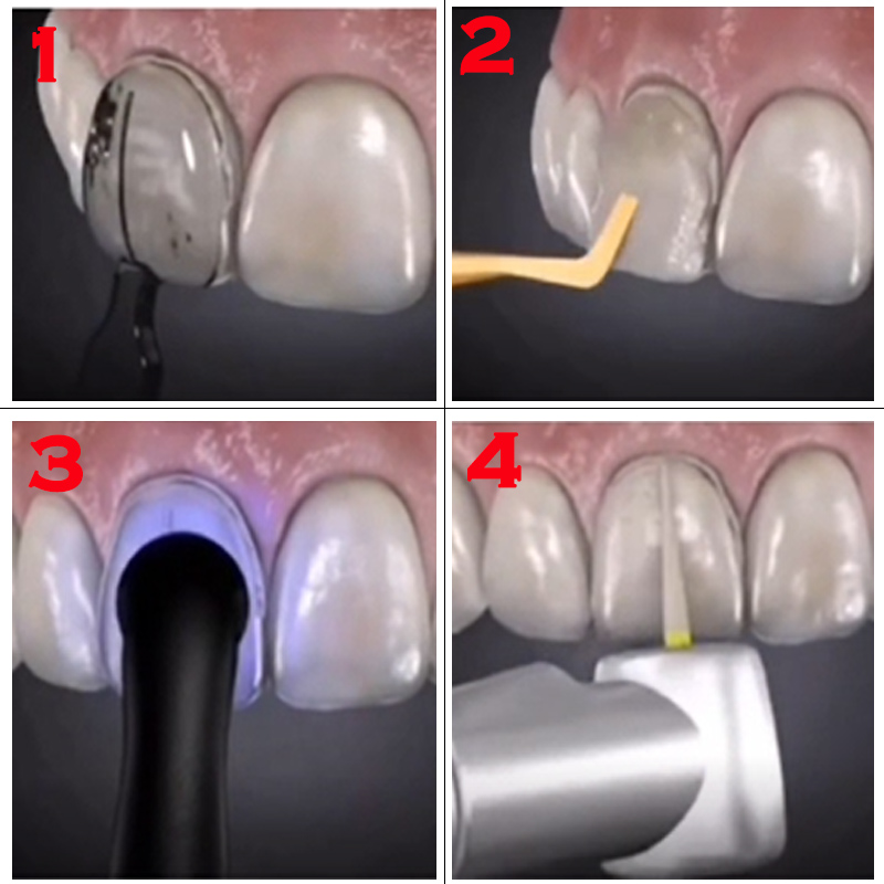 Dental Mold for Composite Resi - Teeth Whitening Moulds review and price