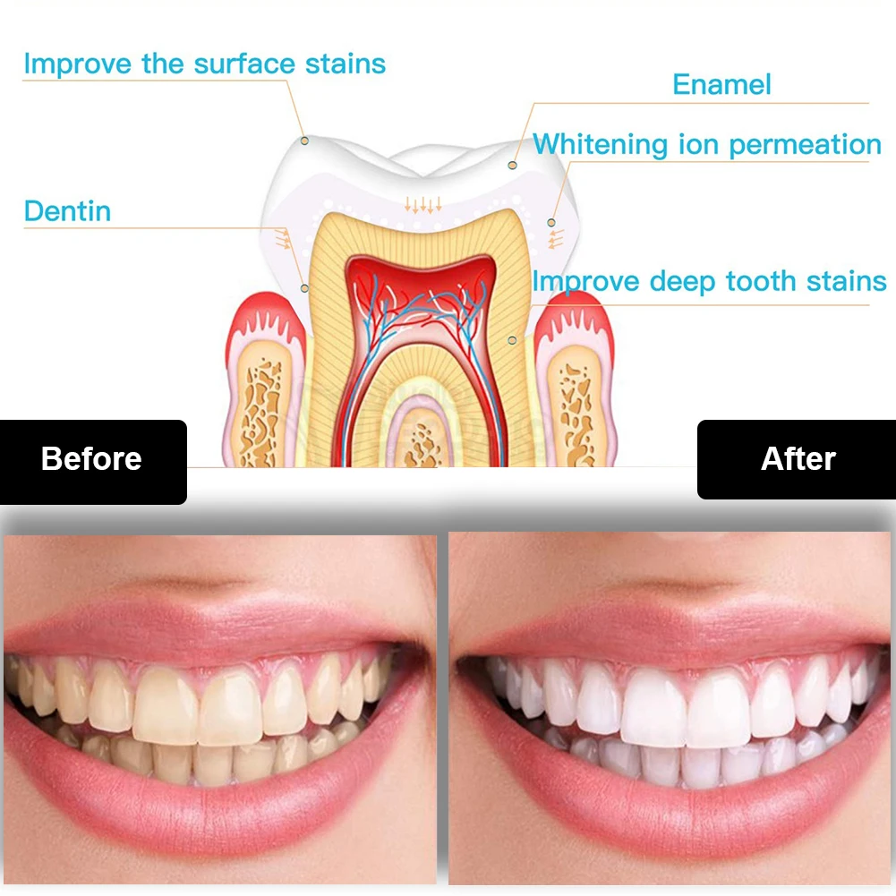Dental Teeth Whitening Kit Min - Teeth Whitening Levels review and price