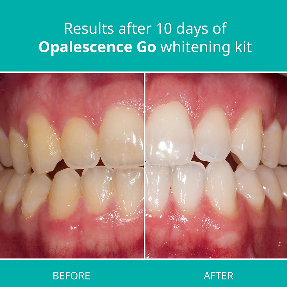 Opalescence Go Teeth Whitening - Teeth Whitening Opalescence Go review and price